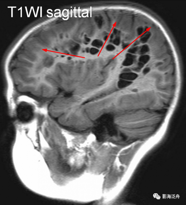 VR腔隙、腔梗灶、微出血、脫髓鞘，傻傻分不清？快看這裡
