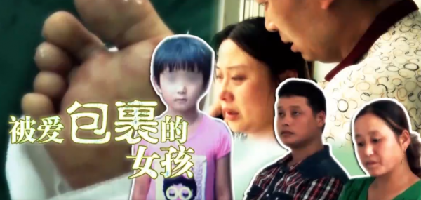 6年前，那個患上罕見怪病的8歲女孩，移植“豬皮”後成功治癒出院