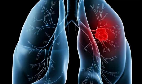 肺癌骨轉移可以這樣運用中醫藥治療——內附真實病例 肺癌骨轉移可以這樣運用中醫藥治療——內附真實病例