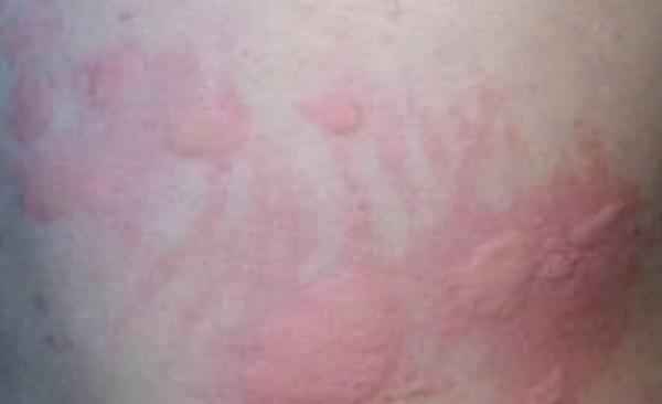 中醫分型治療蕁麻疹，趙醫生帶你解讀十種型別蕁麻疹