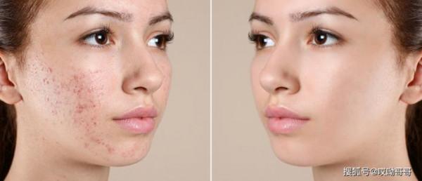 扶正消毒飲——治療痘痘、瘡家的重要方劑