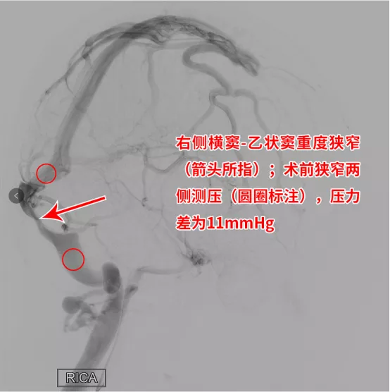 莫名頭痛伴視力模糊，竟是靜脈竇狹窄！支架置入“天塹變通途”