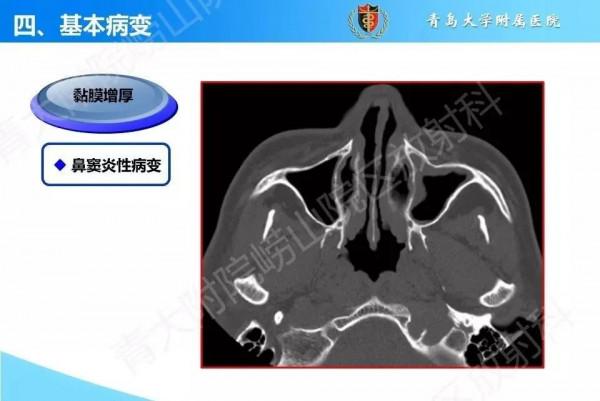 頭頸五官CT斷層解剖圖及常見病影像診斷