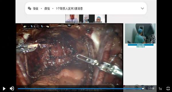 解放軍總醫院泌尿外科醫學部李宏召教授團隊機器人手術突破1000例 解放軍總醫院泌尿外科醫學部李宏召教授團隊機器人手術突破1000例