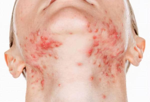 痘痘疤痕增生鼓起來了怎麼辦? 痘痘疤痕增生鼓起來了怎麼辦?