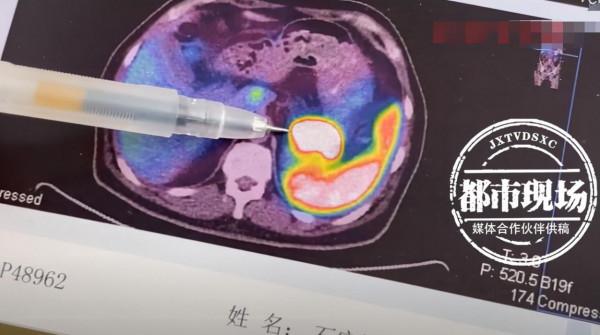 有沒有搞錯?治了2年的“面板病”,竟然是腫瘤 有沒有搞錯?治了2年的“面板病”,竟然是腫瘤