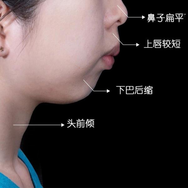 下巴後縮還嘴凸?記住這2招,拒絕變美絆腳石 下巴後縮還嘴凸?記住這2招,拒絕變美絆腳石