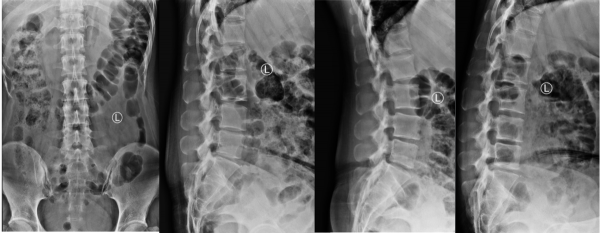 榮譽背後的傷與痛——記一位腰椎間盤突出症運動員