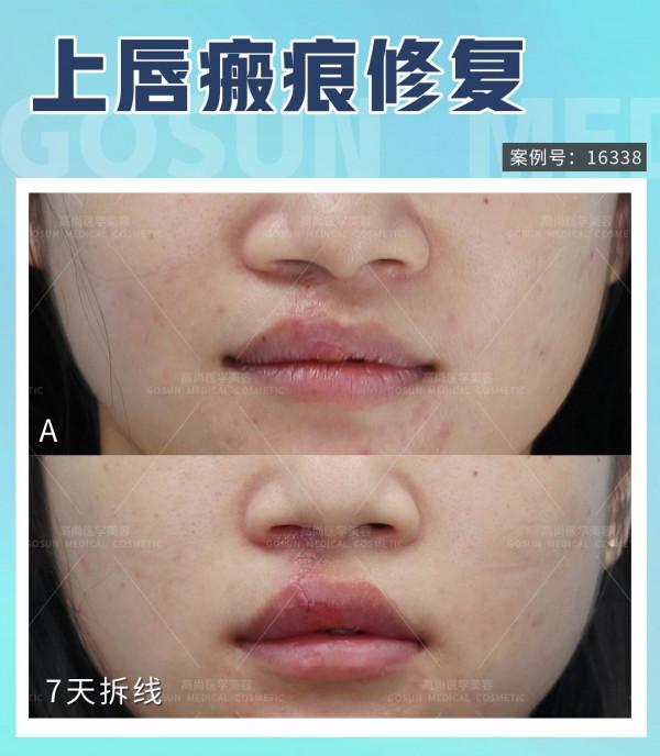 唇裂二期紅唇修復可以達到什麼效果？