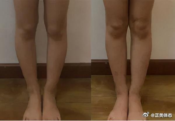 最全腿型解析都在這,腿不直的人對號入座 最全腿型解析都在這,腿不直的人對號入座