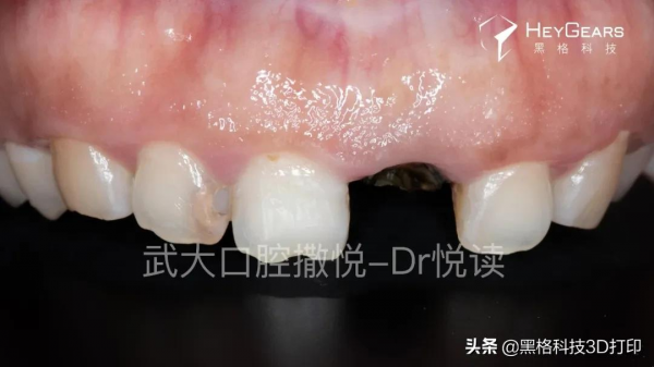 黑格科技丨病例分享：美學區即拔即種微創治療