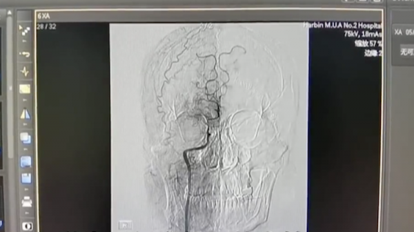 27歲小夥患上腦梗 大腦內血管竟“煙霧繚繞”