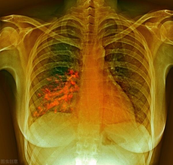 如何預防老年人嗆咳? 如何預防老年人嗆咳?