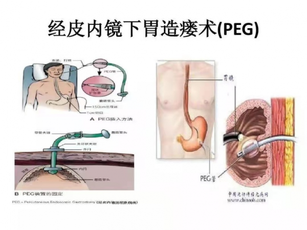 無法正常進食，經皮內鏡下胃造瘻術（PEG）幫助患者好好吃頓飯
