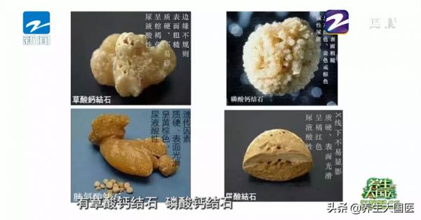 這種病痛起來滿地打滾!“營養蔬菜”吃法錯誤是誘因之一 這種病痛起來滿地打滾!“營養蔬菜”吃法錯誤是誘因之一