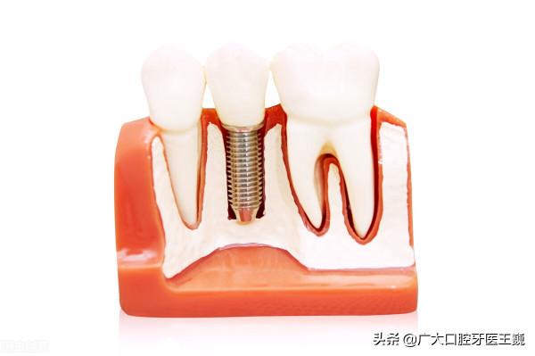 不痛不用拔?這些殘根危害可不小,嚴重要截骨 不痛不用拔?這些殘根危害可不小,嚴重要截骨