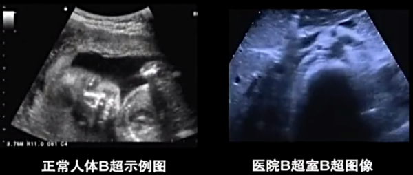 男子體檢B超照不到內臟，醫生仔細檢查發現不妙，馬上勸男子轉院