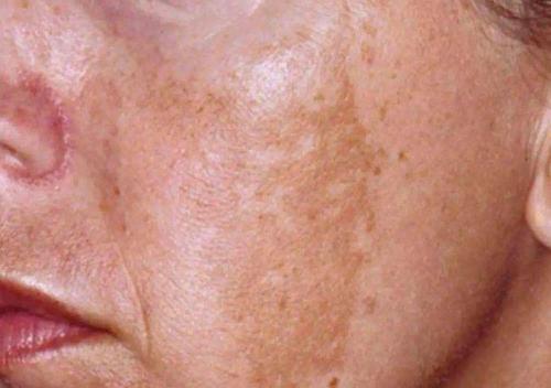 黃褐斑一化斑湯