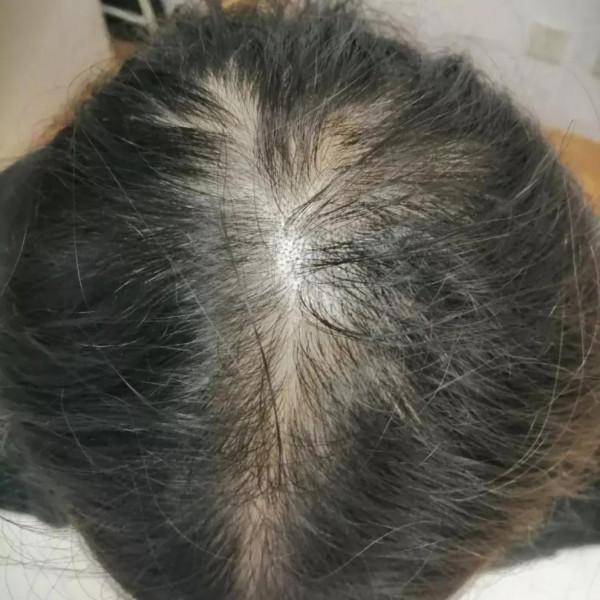 脫髮嚴重，頭頂都禿了，黑米黑芝麻居然真的長頭髮