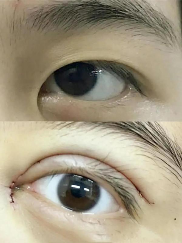 做雙眼皮前醫生需要設計，她們到底在設計些什麼？