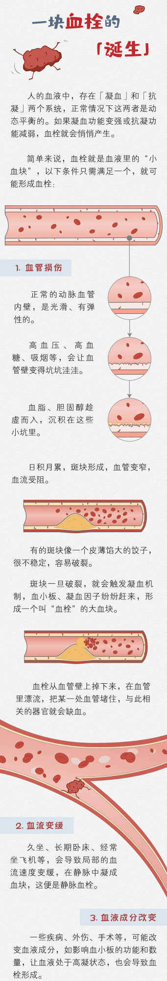 一塊「血栓」的危險漂流之旅 一塊「血栓」的危險漂流之旅