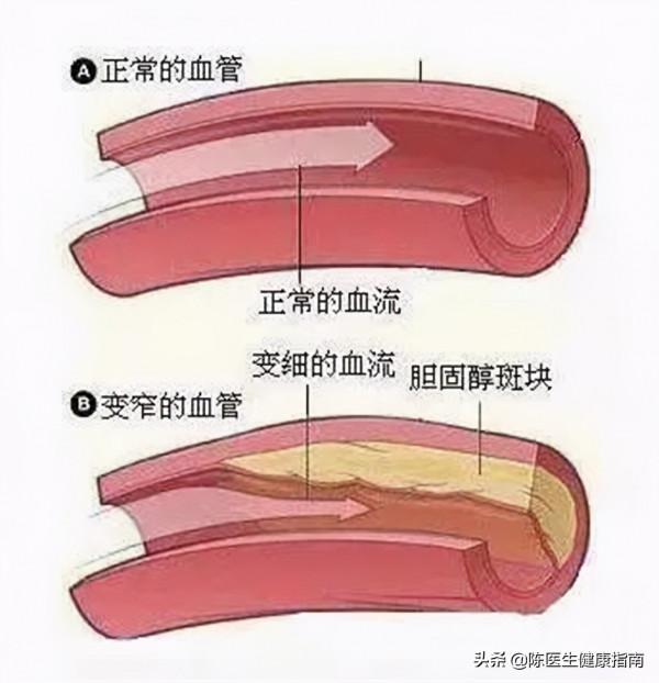 心臟支架手術後，到底能不能喝酒？看醫生怎麼說