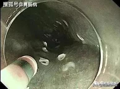 嗓子幹癢、有異物感&period;&period;&period;當成咽炎，差點要命