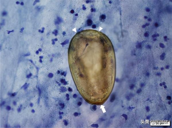 醉蟹吃過嗎?如果你食用的是這種醉蟹,醫生提醒最好去醫院檢查下 醉蟹吃過嗎?如果你食用的是這種醉蟹,醫生提醒最好去醫院檢查下