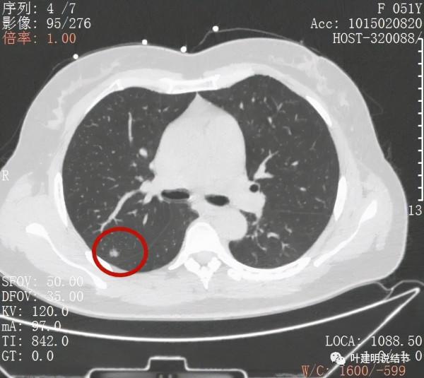 指南說小於5毫米的肺結節不需要隨訪，打臉來了