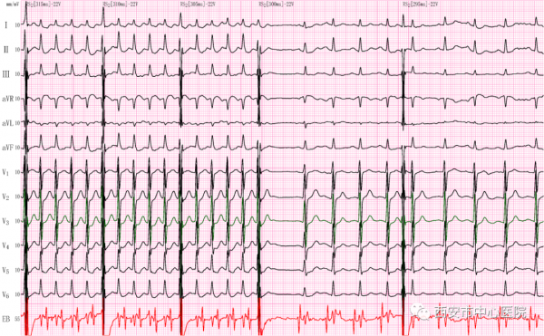 “食道心電圖、食道調搏” 您瞭解嗎? “食道心電圖、食道調搏” 您瞭解嗎?