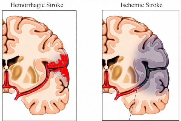 從診斷高血壓到腦出血去世,10年間這位患者經歷了什麼? 從診斷高血壓到腦出血去世,10年間這位患者經歷了什麼?