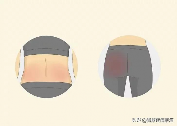 是肌肉勞損還是椎間盤突出，關於背疼你需要知道這些
