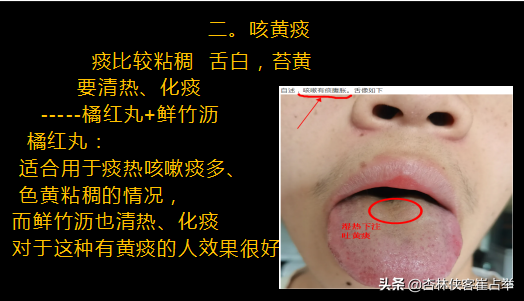 咳白痰、黃痰、清稀泡沫痰，3種情況3種原因，教你一分鐘辨別