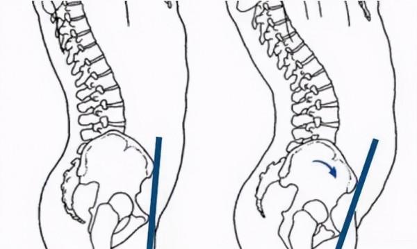 骨盆前傾危害大!4種練習緩解你的骨盆前傾 骨盆前傾危害大!4種練習緩解你的骨盆前傾