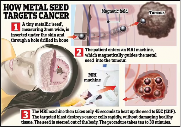 新法治癌:小鋼球經MRI引導至腫瘤,迅速加熱並炸燬癌細胞 新法治癌:小鋼球經MRI引導至腫瘤,迅速加熱並炸燬癌細胞