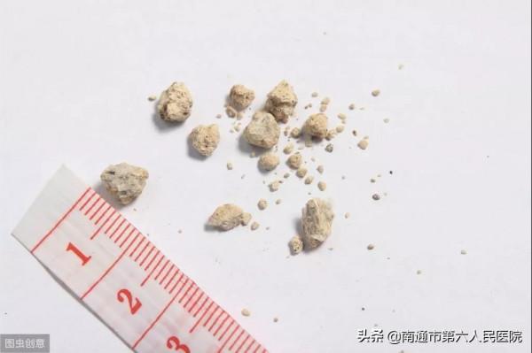 腎結石 | 體外碎石效果不佳應該咋辦？