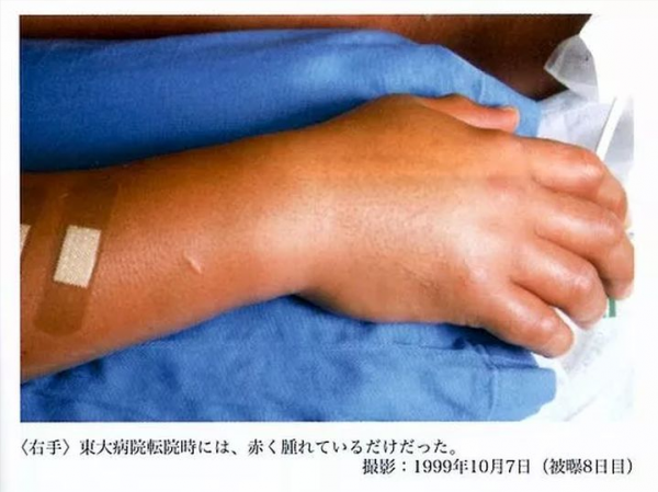 最恐怖的死法：83天的核事故救治，他看著自己一點點腐爛成活死人