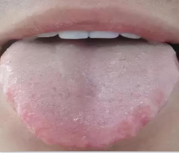 舌頭邊緣有齒痕，舌苔中間有裂紋？3種齒痕5種裂紋，你是哪一種？