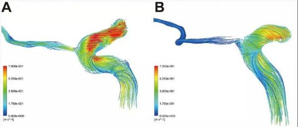 北京友誼醫院王豔玲教授團隊首次構建急性冠狀動脈綜合徵眼動脈模型與血流模擬模擬