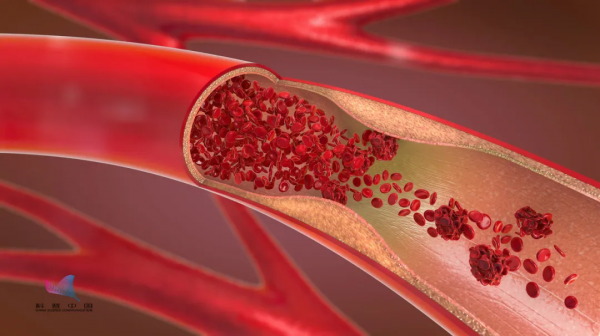 定期輸液能疏通血管？真是害人不淺！看看什麼是正確的做法…