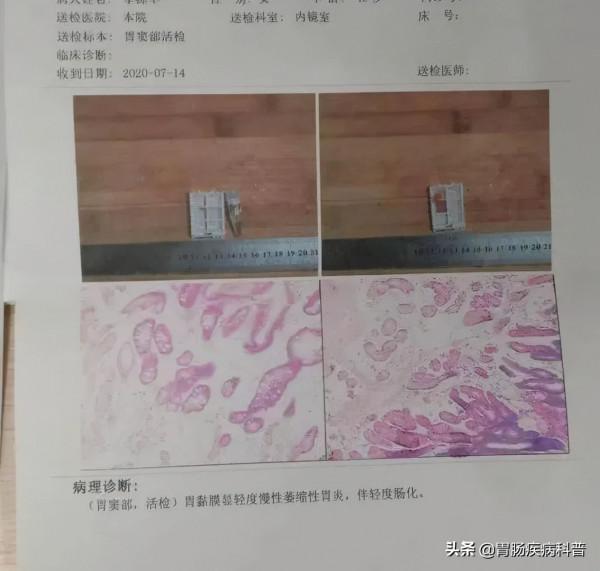 葉酸+維生素B12，治療慢性萎縮性胃炎