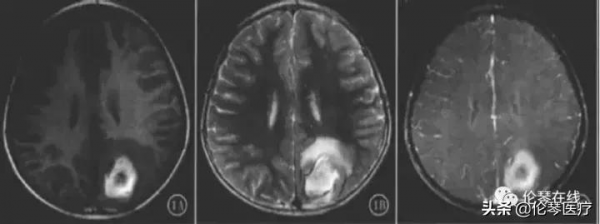 這種吃螃蟹吃出的怪病,影像醫生都是怎麼診斷的?|倫琴醫療 這種吃螃蟹吃出的怪病,影像醫生都是怎麼診斷的?|倫琴醫療
