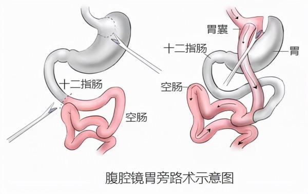 330斤“重磅小夥”，一月減掉了50斤