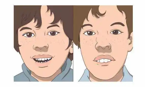 娃睡覺張嘴越長越醜？很多小孩都有的腺樣體肥大，一文說清