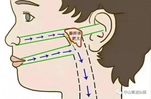 關於兒童腺樣體肥大，這些知識家長需掌握