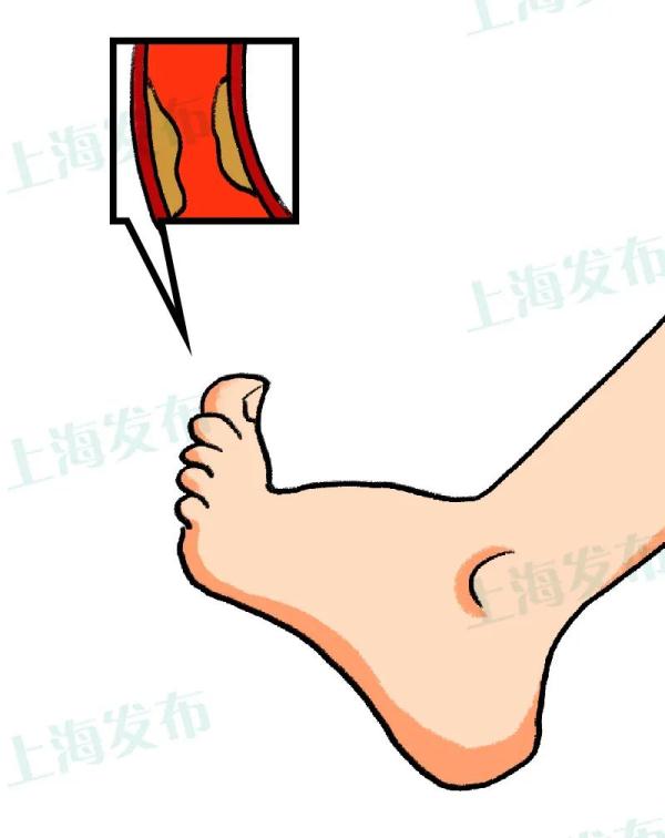 血糖高為啥爛jio？操勞一生的腳需要特別的愛