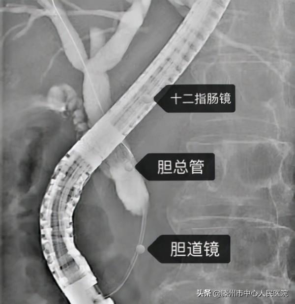 消化內科成功開展兩例新技術為患者帶來福音