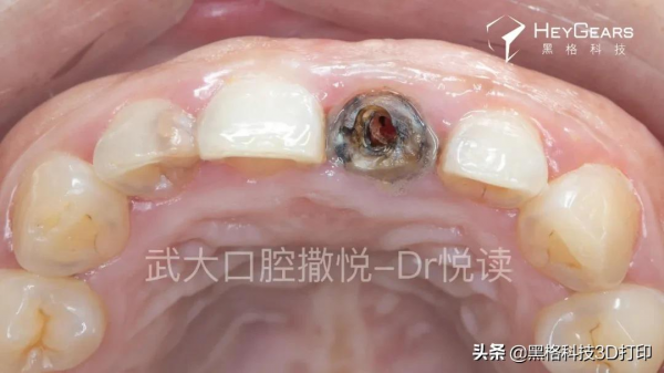 黑格科技丨病例分享：美學區即拔即種微創治療