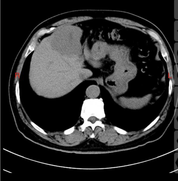 從AFP異常到發現肝癌，需要多久？一個患者的查體經歷告訴了我