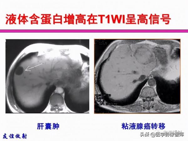 臨床MRI訊號分析基礎：常規序列及DWI序列